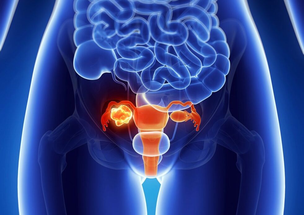 Fra vun der Ovary Pathologie ënner dem Afloss vun Alkohol